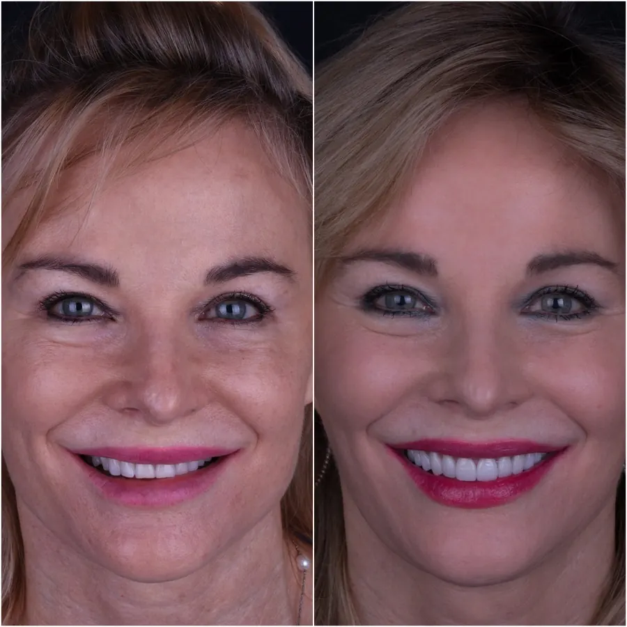 A patient of Dr. Tindal before treatment, left, and after, right.