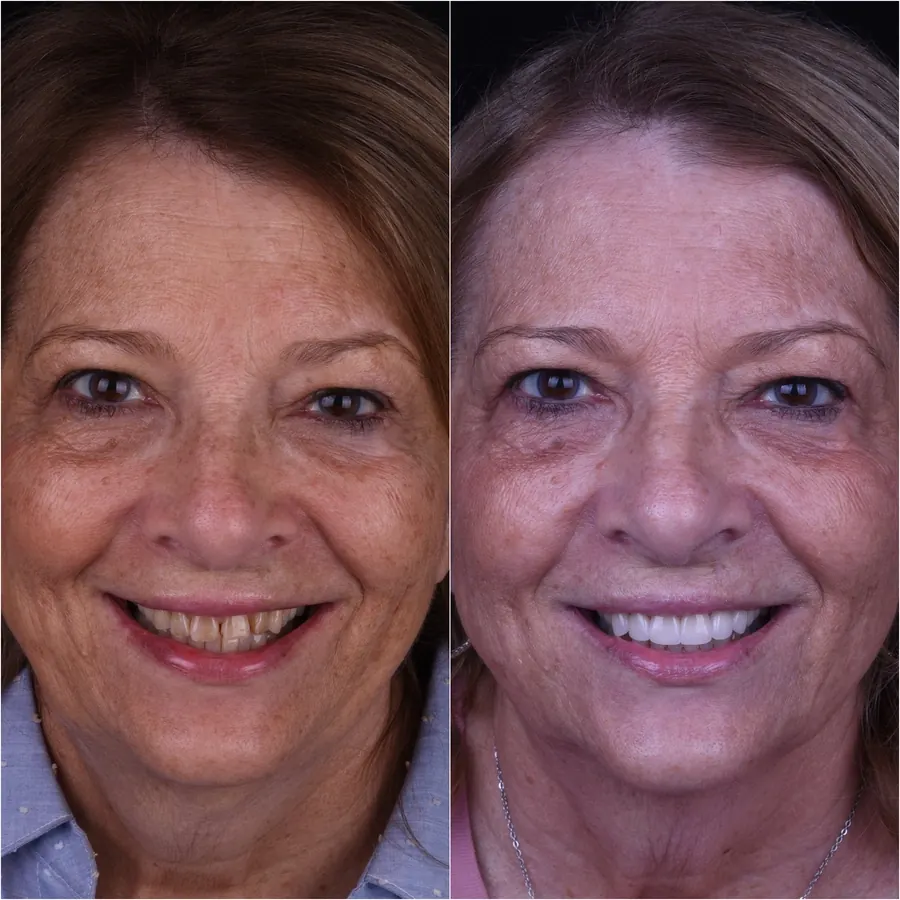 A second patient of Dr. Tindal before treatment, left, and after, right.
